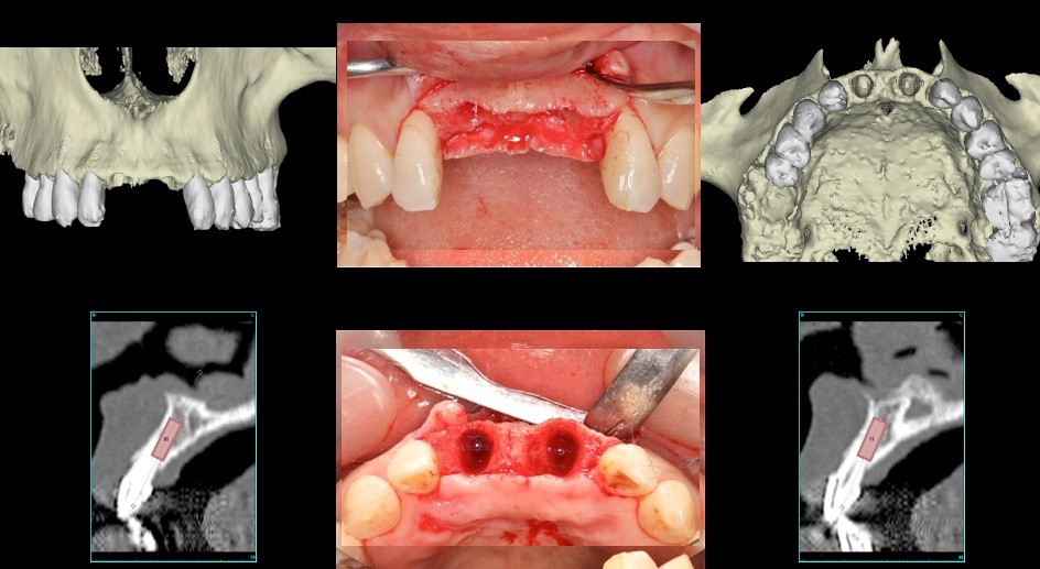 上顎中切歯　抜歯即時のケース