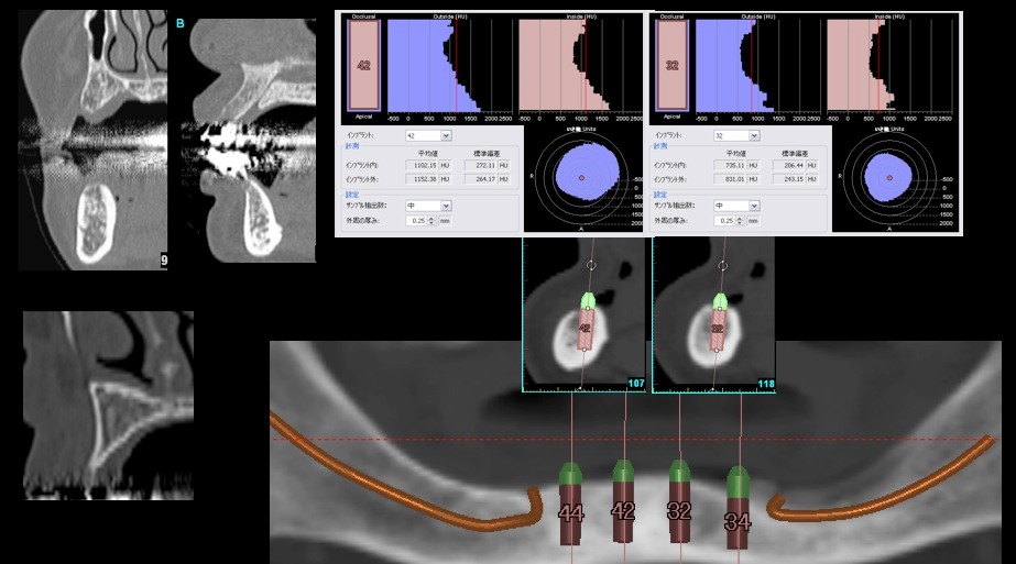 フライスドリルは骨質の不均一な部位に応用する