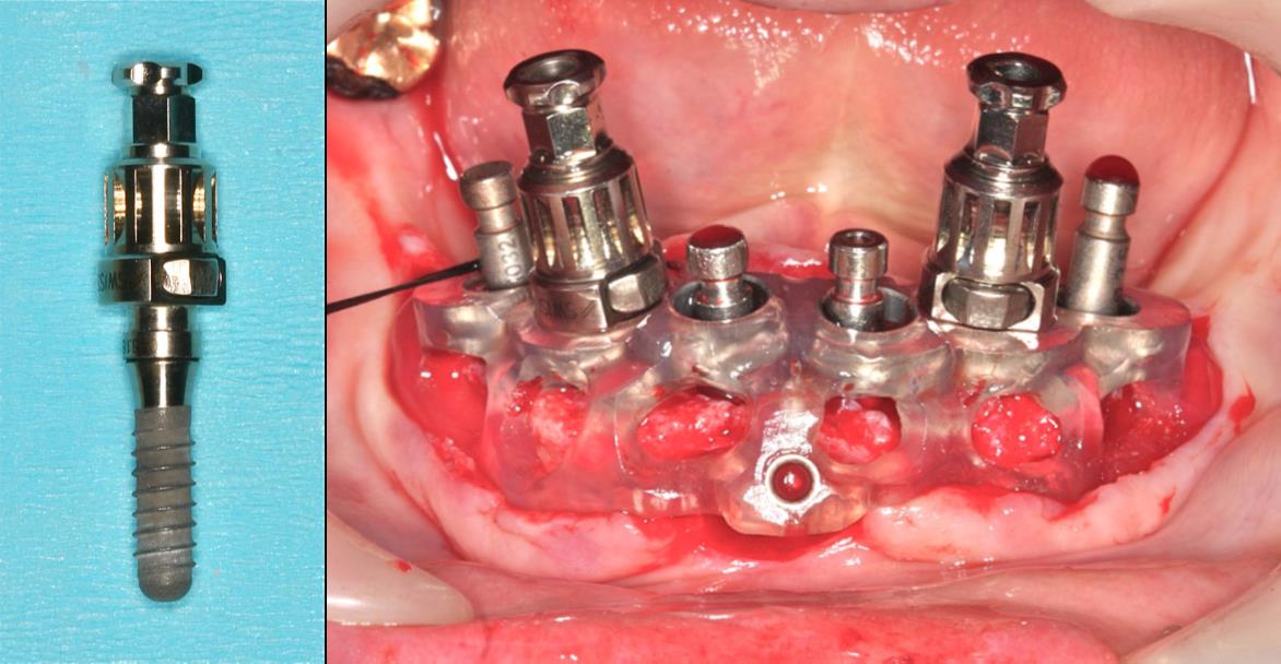 温故知新　従来のマウントでガイドを固定している