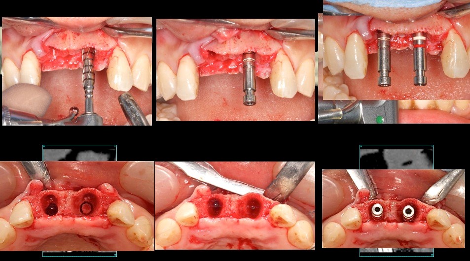 上顎中切歯　抜歯即時のケース