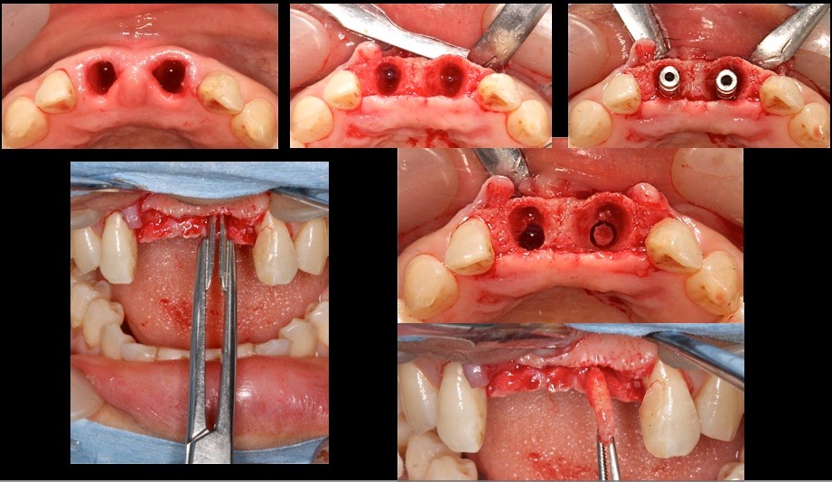 クリッケラー先生考案の骨採取の鉗子にて骨尖採取