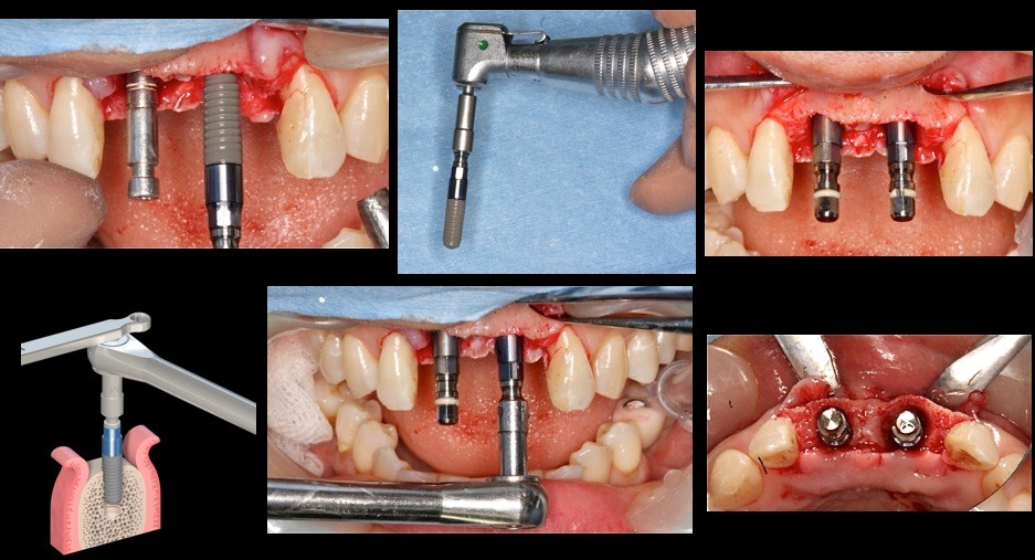 インプラント埋入　抜歯窩とインプラントに空隙があることがわかる