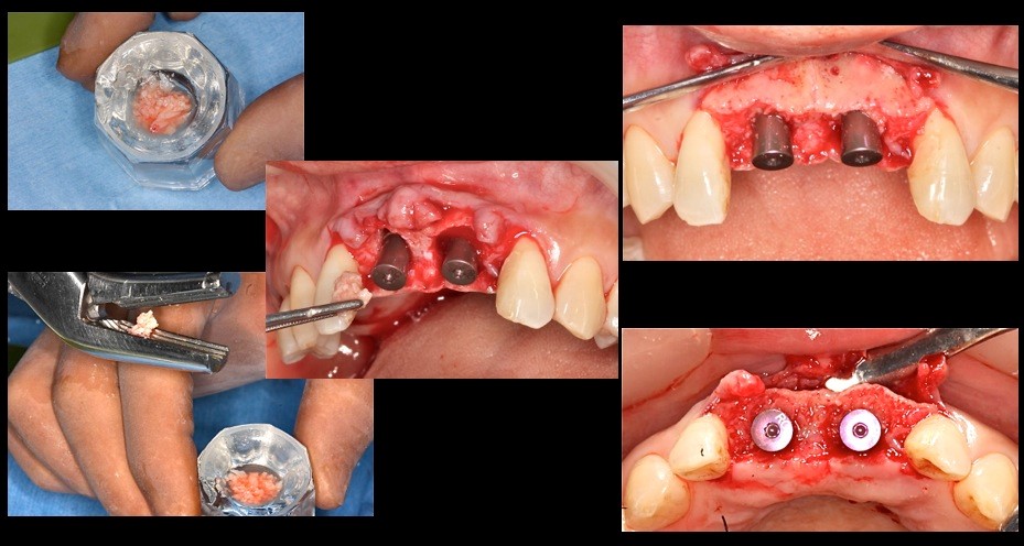 この部位に中切歯2本分の骨尖を砕いて隙間に填塞する　右下の写真で十分填塞できていることが確認できる。