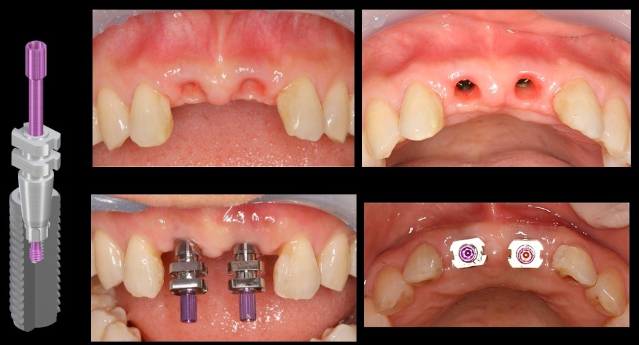 術後3ヶ月　印象時の軟組織の状態