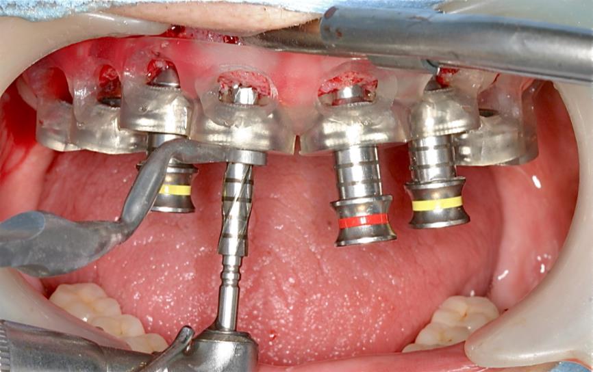 ガイドサージェリーのスターティングに　また形成にもガイドの動揺を最小限にすることができる。ひいては所定の位置に近い埋入が可能になる