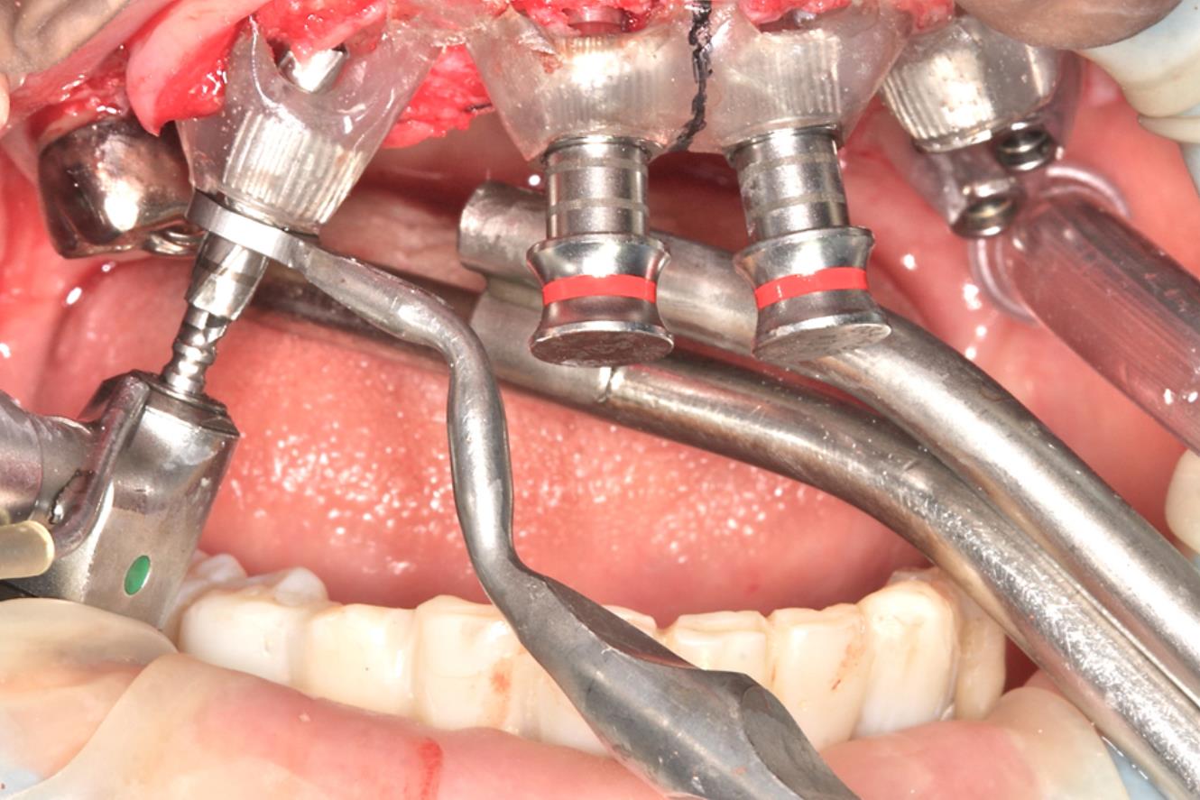 傾斜埋入の際の形成にもドリルのずれが無く、ガイドを揺さぶることも起こりにくい